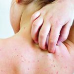 হামের উপসর্গ নিয়ে আরো ১৭ শিশু হাসপাতালে ভর্তি দুইজনের শনাক্ত