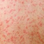 চট্টগ্রামে হামের সংক্রমণ ধীরে ধীরে বাড়ছে। সর্বশেষ তথ্য অনুযায়ী, নতুন করে আরও চার শিশুর শরীরে হাম শনাক্ত হয়েছে। একই সময়ে উপসর্গ নিয়ে বিভিন্ন হাসপাতালে ভর্তি হয়েছে ১৬ জন শিশু। স্বাস্থ্য বিভাগের সূত্রে জানা যায়, নতুন শনাক্ত চার শিশুর মধ্যে দুজন নগরীর এবং বাকি দুজন উপজেলার বাসিন্দা। এ নিয়ে জেলায় মোট হাম আক্রান্তের সংখ্যা দাঁড়িয়েছে ১১ জনে। পাশাপাশি একজনের শরীরে রুবেলা শনাক্ত হয়েছে।